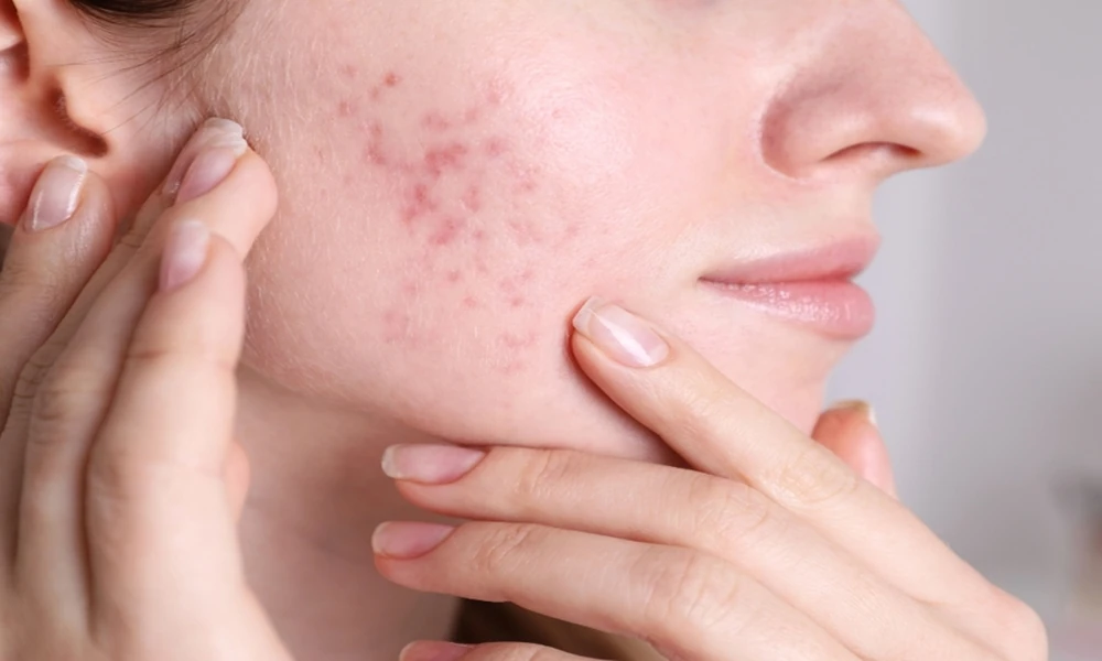 Acne Scars Becoming Noticeable? Specialized Care Can Address Uneven Skin Texture