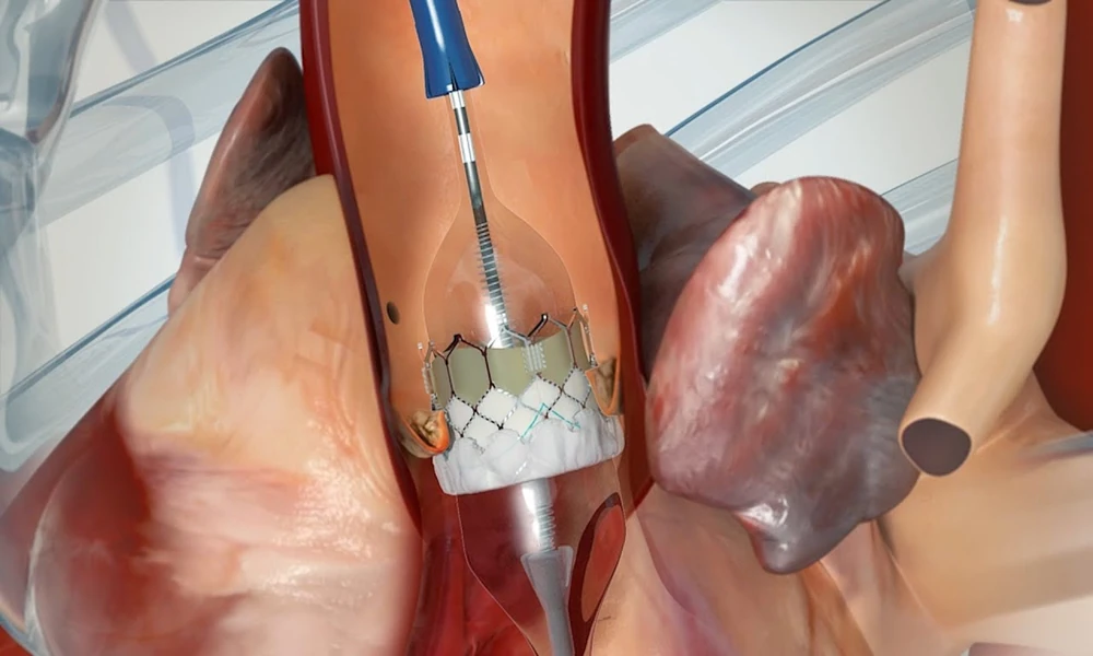 Interventional Cardiologist in Mumbai: What They Do, When You Need One and How to Choose